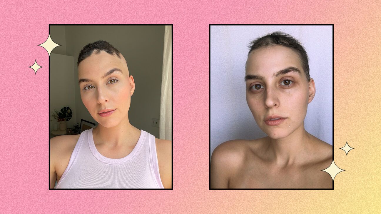 Two photos of Robyn Germyn, a social influencer who lives with alopecia areata; one photo is her crying while in the other she is smiling